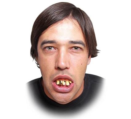 Prótese dentária de ouro