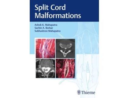 Livro Split Cord Malformations de Ashok Mahapatra, Sachin Borkar et al. (Inglês - Capa Dura)