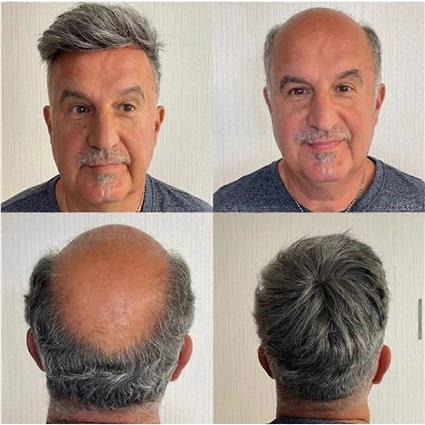 Redkid Peça de cabelo dos homens Natrual sistemas de substituição de cabelo humano Toupee para homens pele fina com Mono Lace Top e o Pu durável de...