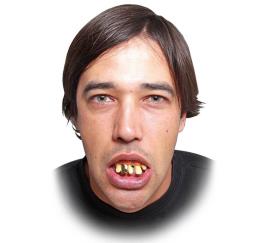 Prótese dentária de ouro