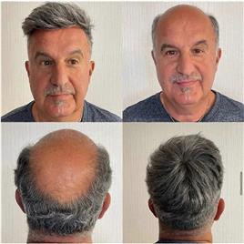 Redkid Peça de cabelo dos homens Natrual sistemas de substituição de cabelo humano Toupee para homens pele fina com Mono Lace Top e o Pu durável de...